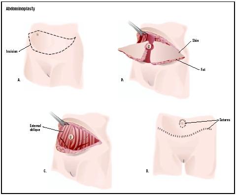 In an abdominoplasty, or tummy tuck, an incision is made in the abdomen (usually from hip bone to hip bone). Excess skin and fat is removed (B). The muscles may be tightened (C). The navel will be placed into the proper position (D), and the major incision closed beneath it. (Illustration by GGS Inc.)