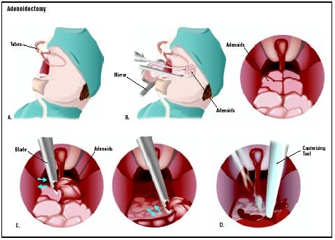 Patient's mouth is held open with tubes (A). A mirror is used to visualize the adenoids during the procedure (B). The adenoids are removed with a side-to-side or front-to-back motion (C). Bleeding is controlled with a cauterizing tool (D). (Illustration by GGS Inc.)