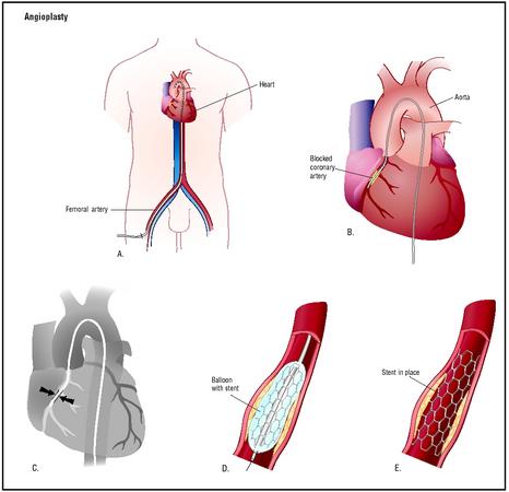 The balloon is inflated, opening the artery (D). The stent holds the artery 