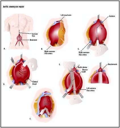 How are aortic aneurysms treated?