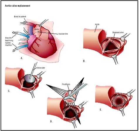 The heart is accessed through a chest incision (A). The patient's heart function is replaced by the heart-lung machine. The aorta is cut open to reveal a diseased aortic valve (B), which is then removed. A valve sizer is placed in the opening to determine the size of prosthesis needed (C). A prosthetic valve is sutured in place (D and E). (Illustration by Argosy.)