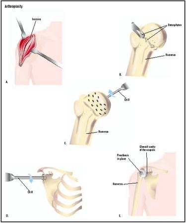 In this shoulder arthroplasty procedure, an incision is made into the shoulder (A). The head of the humerus (upper arm bone) is removed from the shoulder joint, and bone growths, or osteophytes, are removed (B). Small holes are drilled into the head to accept the prosthesis (C). Similar holes are drilled in the glenoid cavity (shoulder joint) (D). The final prosthesis improves shoulder function (E). (Illustration by GGS Inc.)