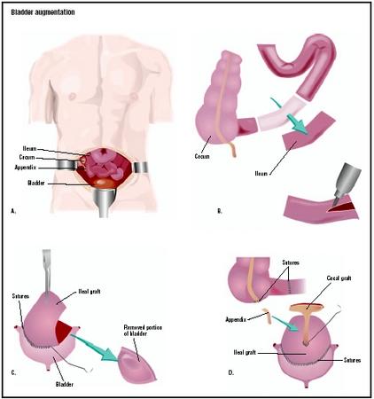 During a bladder augmentation procedure, an incision is made in the abdomen to expose the intestines and bladder (A). A section of ileum (small intestine) is removed and opened (B). After being sterilized, it is grafted onto the bladder to increase its capacity (C). The appendix and cecum (large intestine) may also be used (D). (Illustration by GGS Inc.)