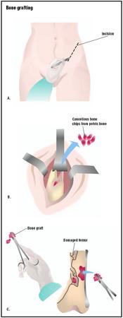 For bone grafting, an incision is made in the donor's hip (A). Pieces of bone are chipped off and removed (B). The bone materials are then transferred to the recipient area, in this case a femur that has been badly broken, to strengthen the bone (C). (Illustration by GGS Inc.)