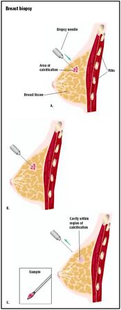 During a needle biopsy on the breast, a local anesthetic is used, and a needle with a looped end is inserted into the potential tumor (A). A sample is taken (B), and the needle withdrawn (C). The sample is sent to a laboratory for analysis. (Illustration by GGS Inc.)