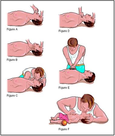 CPR in basic life support. Figure A: The victim should be flat on his back and his mouth should be checked for debris. Figure B: If the victim is unconscious, open airway, lift neck, and tilt head back. Figure C: If victim is not breathing, begin artificial breathing with four quick full breaths. Figure D: Check for carotid pulse. Figure E: If pulse is absent, begin artificial circulation by depressing sternum. Figure F: Mouth-to-mouth resuscitation of an infant. (Illustration by Electronic Illustrators Group.)
