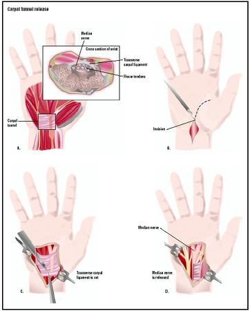 To perform a carpal tunnel release, the surgeon makes an incision in the palm of the hand, above the area of the carpal tunnel (B). The carpal ligament going across the hand is severed (C), releasing pressure on the median nerve (D). (Illustration by GGS Inc.)