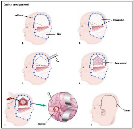 To repair a cerebral aneurysm by craniotomy, an incision is made in the skin on the side of the head (A). Small holes are drilled in the skull (B), and a special saw is used to cut the bone between the holes (C). The bone is removed (D), and the aneurysm is treated (E). The bone is replaced, and the skin is sutured closed (F). (Illustration by GGS Inc.)