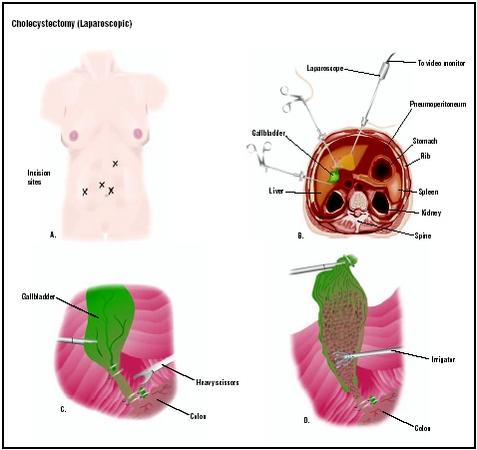 In a laparoscopic cholecystectomy, four small incisions are made in the abdomen (A). The abdomen is filled with carbon dioxide, and the surgeon views internal structures with a video monitor (B). The gallbladder is located and cut with laparoscopic scissors (C). It is then removed through an incision (D). (Illustration by GGS Inc.)