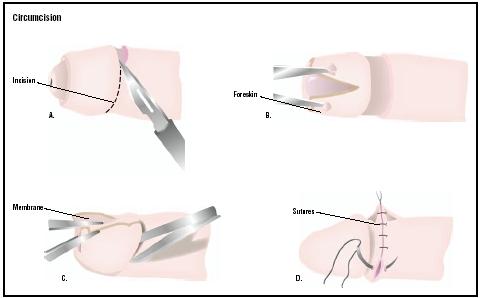 During a circumcision, the outer layer of the foreskin around the penis is cut (A). The foreskin is pulled away (B), and the remaining membrane is cut away (C). Sutures are used to stitch the area (D). (Illustration by GGS Inc.)