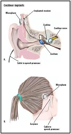 A cochlear implant has a microphone outside the ear that transmits sounds to an implanted receiver. In turn, the receiver transmits electrical impulses to the cochlea and cochlear nerve, which is stimulated in normal hearing. (Illustration by GGS Inc.)
