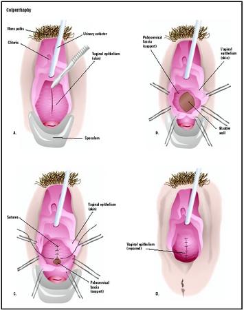 In this anterior colporrhaphy, a speculum is used to hold open the vagina, and the cystocele is visualized (A). The wall of the vagina is cut open to reveal an opening in the supporting structures, or fascia (B). The defect is closed (C), and the vaginal skin is repaired (D). (Illustration by GGS Inc.)