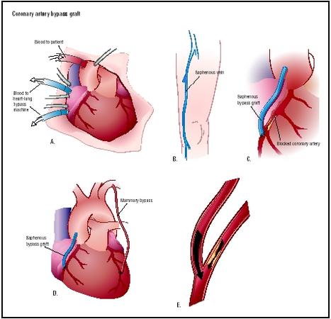 During a coronary artery bypass graft (CABG), the chest is opened to visualize the heart (A). A heart-lung machine takes over the function of the heart during the procedure. A portion of the saphenous vein of the leg is removed (B). This vessel is used to bypass a blockage of the coronary artery. It is attached from the aorta past the point of blockage (C). Another option is to bypass a blockage with the mammary artery (D). The bypass increases blood flow to the area served by the coronary artery (E). (Illustration by Argosy.)