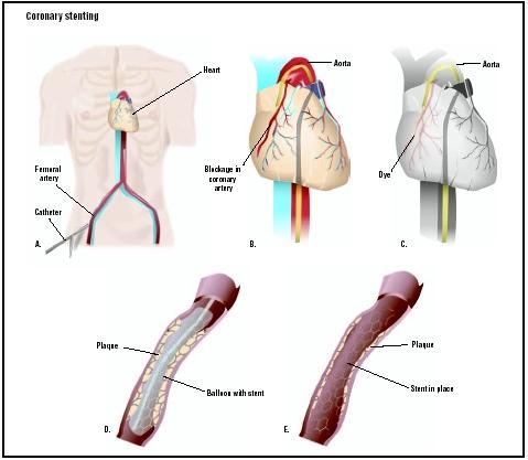 During coronary stenting, a catheter is fed into the femoral artery of the upper leg (A). The catheter is fed up to coronary arteries to an area of blockage (B). A dye is released, allowing visualization of the blockage (C). A stent is placed on the balloon-tipped catheter. The balloon is inflated, opening the artery (D). The stent holds the artery open after the catheter is removed (E). (Illustration by GGS Inc.)