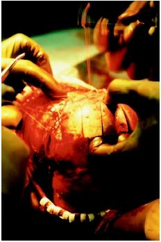 A child undergoing surgery on the skull. (Photograph by Alexander Tsiaras. Science Source/Photo Researchers. Reproduced by permission.)