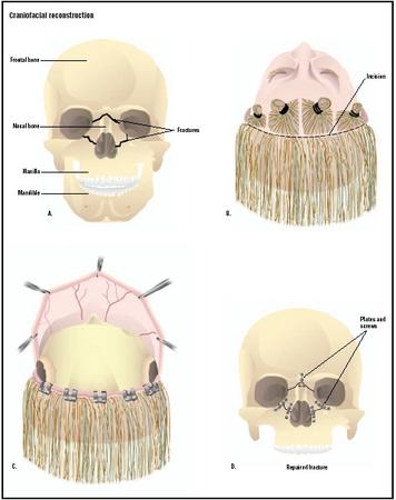 To repair severe fractures around the nasal bone (A), an incision is made into the patient's skin at the top of the head (B). The skin is pulled off the face to expose the fracture (C), which then can be repaired with plates and screws (D). (Illustration by GGS Inc.)