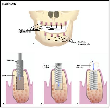 A dental drill is used to make a hole for the implant in the jawbone (B). The bone implant is secured into the drilled hole (C), and the tooth prosthesis is built onto the implant (D). (Illustration by GGS Inc.)