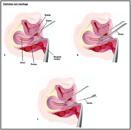For a D & C, the patient lies on her back, and a weighted retractor is placed in the vagina (A). A dilator is used to open the cervix (B), and a curette is used to scrape the inside of the uterus (C). (Illustration by GGS Inc.)