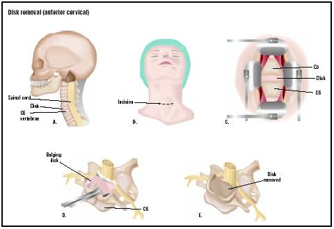 In the anterior cervical disk removal, an incision is made into the patient's neck (B). The cervical disk, which may be herniated, is visualized (C). It is removed completely (D and E). (Illustration by GGS Inc.)