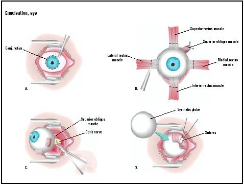 The conjunctiva (outer covering of eye) is removed with blunt scissors (A). The four rectus muscles are removed from their attachments to the eyeball (B). The optic nerve is severed (C), and the eyeball is removed. A synthetic globe replaces the eyeball in the socket, and the rectus muscles are sutured around it (D). (Illustration by GGS Inc.)