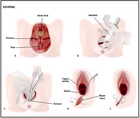  the vagina and the anus A thirddegree episiotomy cuts through skin 