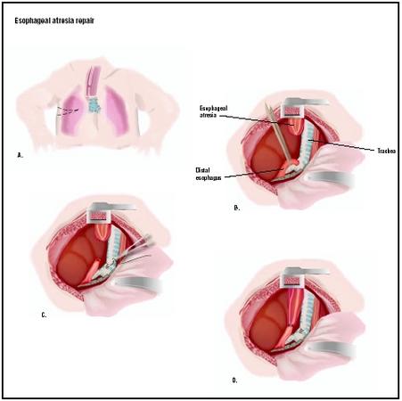 To repair esophageal atresia, an opening is cut into the chest (A). The two parts of the existing esophagus are identified (B). The lower esophagus is detached from the trachea (C) and connected to the upper part of the esophagus (D). The wound in the trachea is closed, and the chest incision is repaired. (Illustration by GGS Inc.)