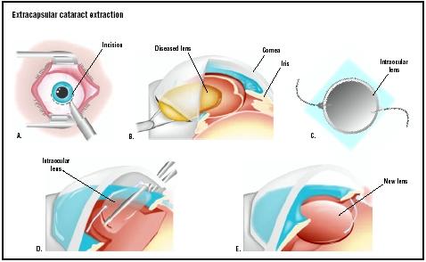 In extracapsular cataract extraction, an incision is made in the eye just beneath the iris, or colored part (A). The diseased lens is pulled out (B). A prosthetic intraocular lens is placed through the incision (D), and is opened to replace the old lens (E). (Illustration by GGS Inc.)