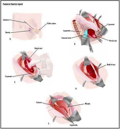 To repair a femoral hernia, an incision is made in the groin area near the hernia (A). Skin and ligaments are pulled aside to expose the hernia (B). The hernia sac is opened, and the contents are pushed back into the abdominal cavity (C). The neck of the sac is tied off, and excess tissue is removed (D). Layers of skin and tissues are repaired (E). (Illustration by GGS Inc.)