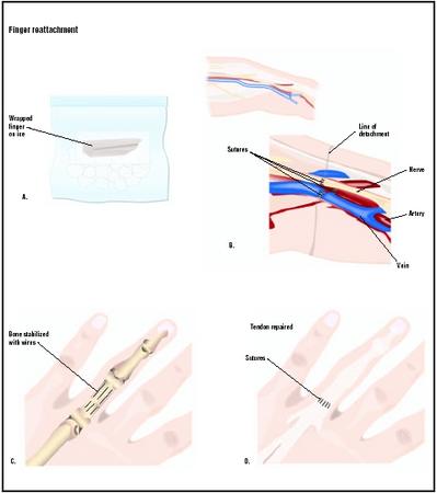 To save a detached finger for reattachment surgery, it should be wrapped in a moist paper towel and put on ice (A). First the surgeon will reattach the blood vessels and nerves of the finger (B). The bone may be repaired with wires (C), and tendons are repaired (D). Skin and muscle wounds are also closed during the procedure. (Illustration by GGS Inc.)
