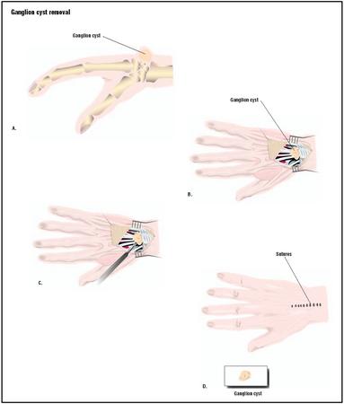 A ganglion cyst is usually attached to a tendon or muscle in the wrist or finger (A). To remove it, the skin is cut open (B), the growth is removed (C), and the skin is sutured closed (D). (Illustration by GGS Inc.)