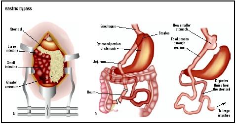 In this Roux-en-Y gastric bypass, a large incision is made down the middle 
