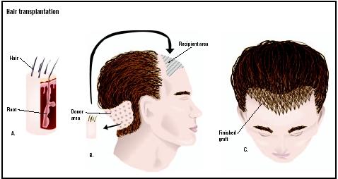 In a hair transplant, plugs of hair and supporting tissues are removed from a donor area at the back of the head (A and B). Pieces of skin are removed at the front of the head, and grafts are placed (C). (Illustration by GGS Inc.)