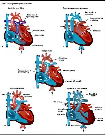 The most common types of congenital heart defects are ventricular septal defect (A), complete transposition of the great vessels (B), tetralogy of Fallot (C), coarctation of the aorta (D), and hypoplastic left heart syndrome (E). (Illustration by GGS Inc.)