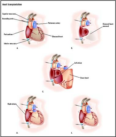 For a heart transplantation, the area around the heart is exposed through a chest incision (A). The blood vessels leading to the heart are clamped, and the heart function is replaced by a heart-lung machine. The diseased heart is removed (B). The donor heart is placed in the chest, and the left atrium is attached (C). The right atrium is connected (D), and the aorta and pulmonary artery are finally attached (E). (Illustration by GGS Inc.)