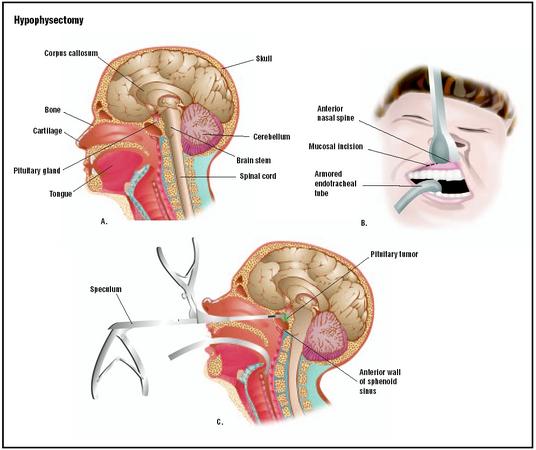 Hypophysectomy is a procedure to access and remove the pituitary gland (A). To access it, an incision is made beneath the patient's upper lip to enter the nasal cavity (B). A speculum is inserted, and special forceps are used to remove the pituitary tumor (C). (Illustration by GGS Inc.)