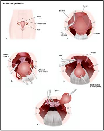 In a hysterectomy, the reproductive organs are accessed through a lower abdominal incision or laparoscopically (A). Ligaments and supporting structures called pedicles connecting the uterus to surrounding organs are severed (B). Arteries to the uterus are severed (C). The uterus, fallopian tubes, and ovaries are removed (D and E). (Illustration by GGS Inc.)
