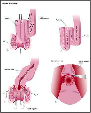 In an ileoanal anastomosis, a pouch is used to create a large section of bowel whose function replaces that of the large intestine, or colon. In this operation, the ileum (part of the small intestine) is shaped into a W-shaped pouch (A). An incision is made (B) to open up the shape and create the larger pouch, which is left open at one end and brought through the rectal area (C). The bottom of the pouch acts as a new rectum, and a new anus is fashioned (D). (Illustration by GGS Inc.)