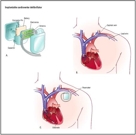 To place an implantable cardioverter defibrillator, a lead wire is inserted into the cephalic vein of the shoulder and fed into the heart chambers (B). An electrode is implanted in the heart muscle of the lower chamber, and the device is attached (C). (Illustration by Argosy.)