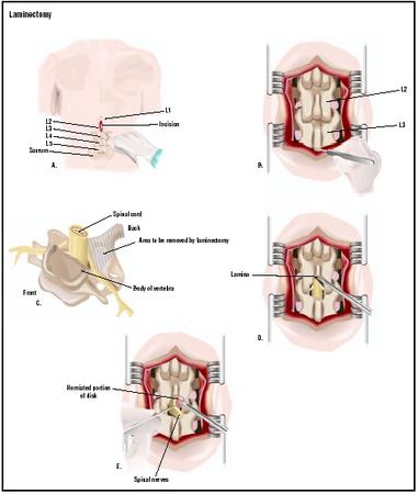 In this posterior (from the back) lumbar laminectomy, an incision is made in the patient's back over the lumbar vertebrae (A). The wound is opened with retractors to expose the L2 and L3 vertebrae (B). A piece of bone at the back of the vertebrae is removed (C and D), allowing a damaged disk to be repaired (E). (Illustration by GGS Inc.)