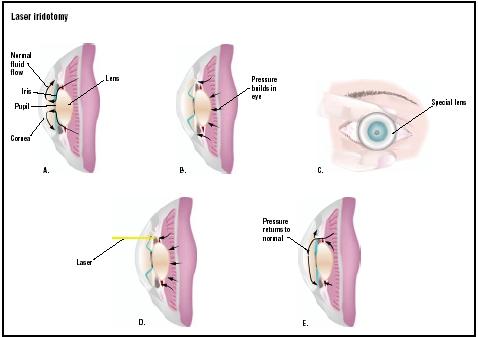 Normally intraocular fluid flows freely between the anterior and posterior sections of the eye (A). As pressure builds in the eye, this circulation is cut off (B). In laser iridotomy, a special lens is placed on the eye (C). A laser is used to create a hole in part of the iris (D), allowing fluid to flow more normally and intraocular pressure to return to normal (E). (Illustration by GGS Inc.)