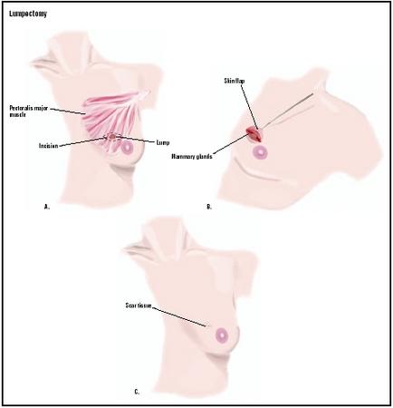 During a lumpectomy, a small incision is made around the area of the lump (A). The skin is pulled back, and the tumor removed (B). The incision is closed (C). (Illustration by GGS Inc.)