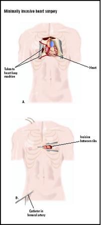 In traditional open heart surgery, a large incision is made in the chest, and the sternum must be broken (A). Minimally invasive surgery uses a much smaller incision between the ribs to access the heart (B). (Illustration by GGS Inc.)