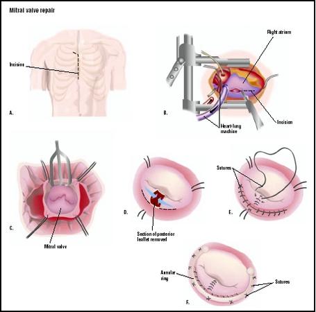 During a mitral valve repair, the patient's chest is opened along the sternum (A). The heart is connected to a heart-lung machine, and an incision is made into the right atrium, or upper chamber of the heart (B), exposing the mitral valve (C). A section of the valve is removed, and the area is repaired with sutures (D and E). A flexible fabric ring may be stitched to the outside of the valve to strengthen it, in a procedure called an annuloplasty (F). (Illustration by GGS Inc.)