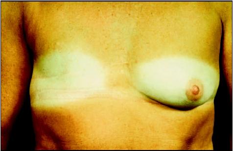 Woman with scars from a modified radical mastectomy. (Biophoto Associates/Science Source. Reproduced by permission.)