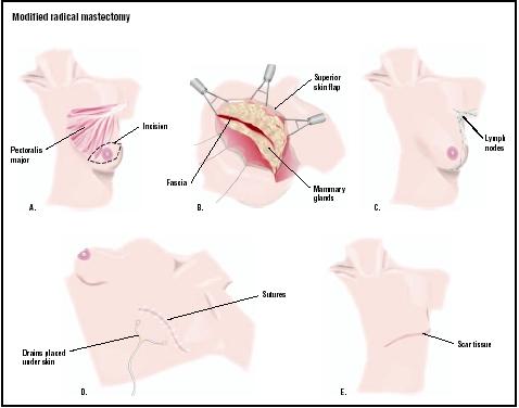 In a modified radical mastectomy, the skin on the breast is cut open (A). The skin is pulled back, and the tumor, lymph nodes, and breast tissue are removed (B and C). The incision is closed (D). (Illustration by GGS Inc.)