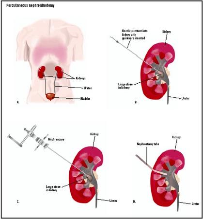 What are the steps involved in having a kidney removed?