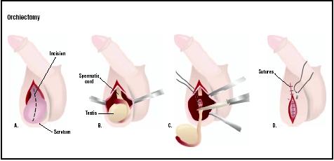 In an orchiectomy, the scrotum is cut open (A). Testicle covering is cut to expose the testis and spermatic cord (B). The cord is tied and cut, removing the testis (C), and the wound is repaired (D). (Illustration by GGS Inc.)