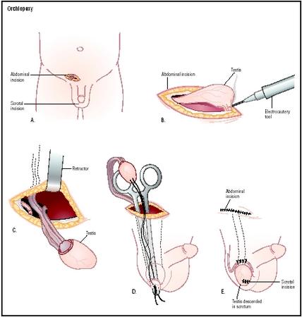 An orchiopexy is used to repair an undescended testicle in childhood. An incision is made into the abdomen, the site of the undescended testicle, and another is made in the scrotum (A). The testis is detached from surrounding tissues (B) and pulled out of the abdominal incision attached to the spermatic cord (C). The testis is then pulled down into the scrotum (D) and stitched into place (E). (Illustration by Argosy.)