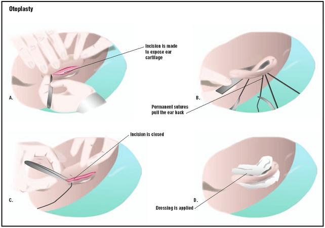 During a setback otoplasty, an incision is made in the back of the ear, exposing cartilage (A). Permanent sutures in the cartilage pull the ear back closer to the skull (B). The incision is closed (C), and dressings are applied (D). (Illustration by GGS Inc.)