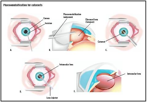 In a phacoemulsification procedure, an incision is first made in the cornea, the outer covering of the eye (A). A phacoemulsification instrument uses ultrasonic waves to break up the cataract (B). Pieces of the cataract are then suctioned out (C). To repair the patient's vision, a folded intraocular lens is pushed through the same incision (D) and opened in place (E). (Illustration by GGS Inc.)